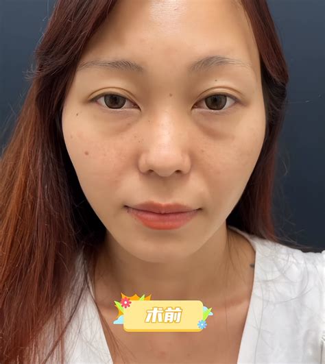 Mustered up the courage to do an incision to remove eye bags, and ...