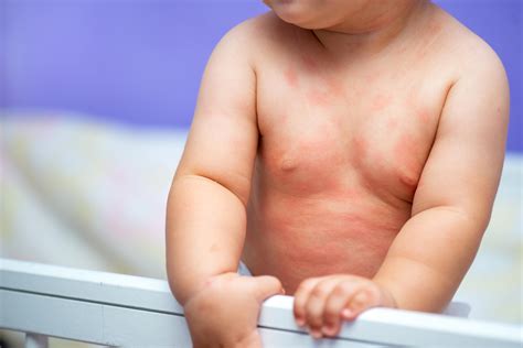 Eczema in babies: Symptoms, Causes, and Treatments