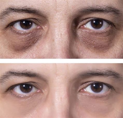 Dark Circles Under Eyes Permanent Treatment at Philip Mayers blog