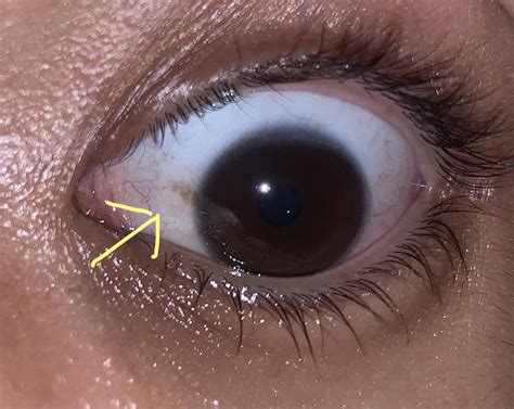 Lacrimal Caruncle Is Swollen