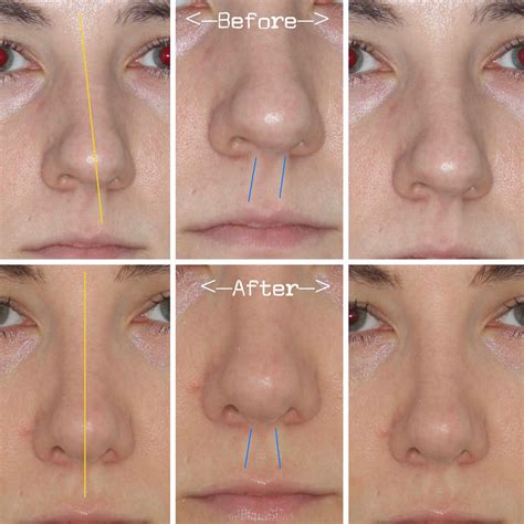 Crooked Nose Before And After