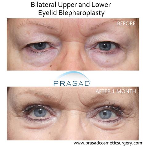 How Hooded Eye Surgery Scars are Minimized | Dr. Prasad Blog
