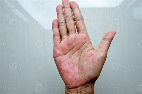 La dermatitis atópica, también conocida como eccema atópico, es un tipo ...