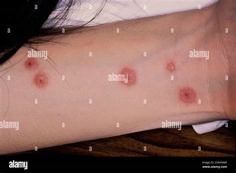*** johnson syndrome hi-res stock photography and images - Alamy