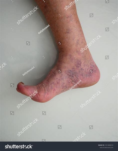 Mottled Foot