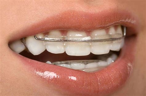 How Long Do You Need to Wear a Teeth Retainer? - Dental Health Clinic