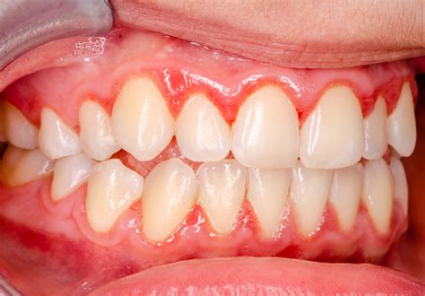 Is Gingivitis Contagious? - West Hollywood Holistic and Cosmetic Dental Care