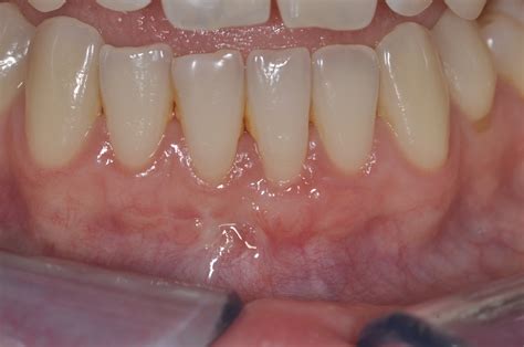 Receding Gum Line