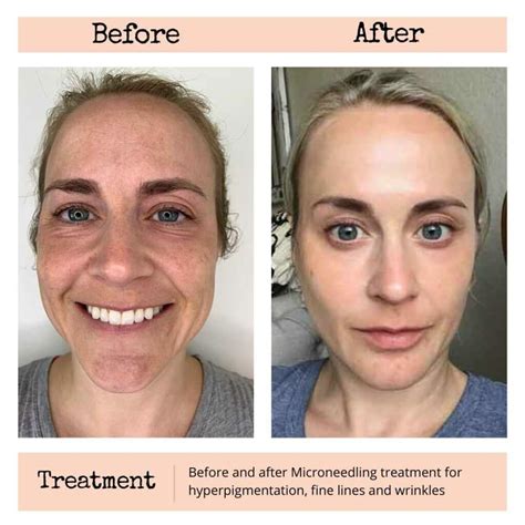 Professional Microneedling Scottsdale | Acne Scars, Wrinkles, and Pigment