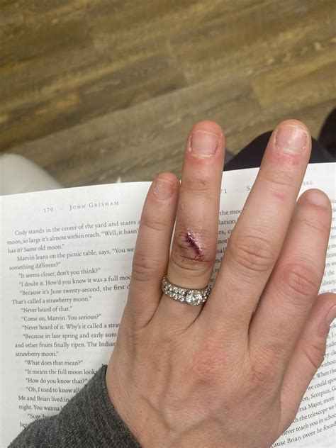 Dermabond and Finger Cut : r/woundcare