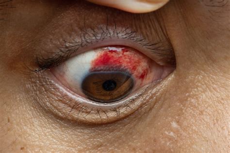 Blood Blister On Eyeball: Causes, Care & When To Worry | CPR First Aid