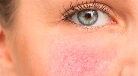 Why Are My Cheeks Always Red? – Grahams Natural USA