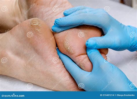 A Pedicure Doctor Examines a Patient`s Feet with Problematic Heels with Cracks and Dry Skin ...