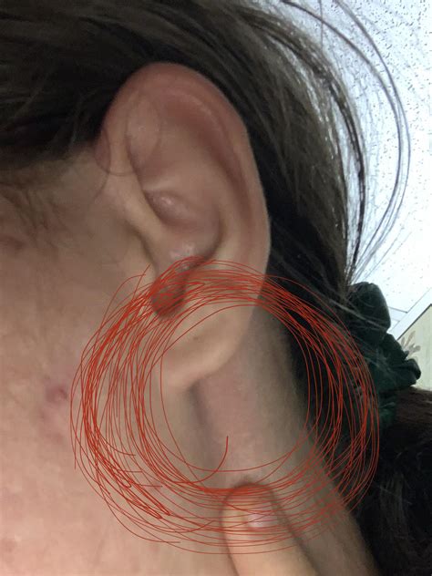 Lump under earlobe I can feel, painless. : r/medical