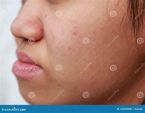 Problems Facial Skin is Acne and Blemishes Stock Photo - Image of face ...