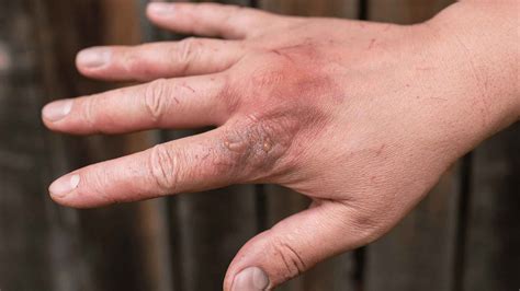 First Aid for Electric Burns | Coast2Coast