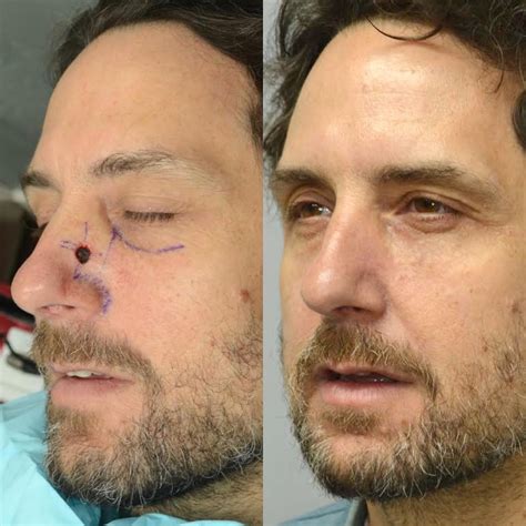 Basal Cell Carcinoma Nose Before After Pictures