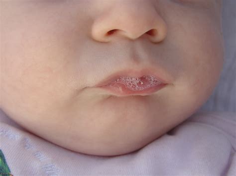 Milk Blister Baby Lip