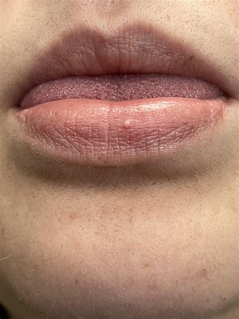 Friend has weird bump on lip, what is it? : r/DermatologyQuestions