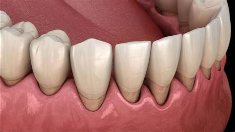 Effective Treatment For Receding Gums - Lema Dental Clinic