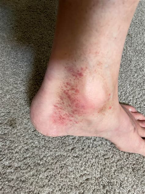Rash or fungus on tops of feet and ankles. Some on leg above ankle. : r ...