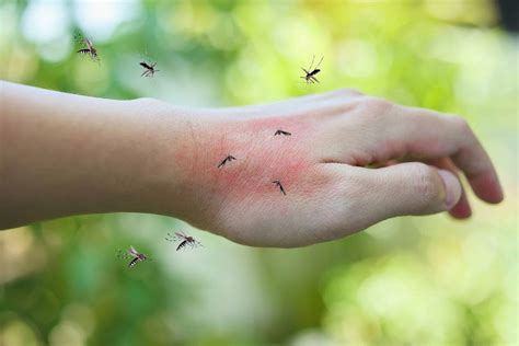 Bite Of Mosquito