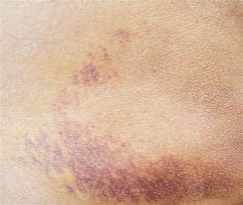 Bruise on the buttock skin injury from accident at home. 44584532 Stock ...