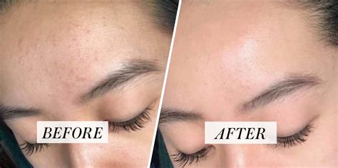 Candida Acne On Forehead