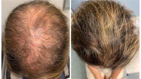 Unveiling the Power of DHT Blockers: Combatting Hair Loss with ...