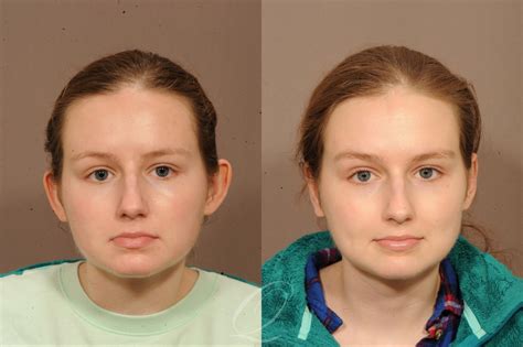 Otoplasty Before And After Patient 125281 | Ear Surgery (Otoplasty)