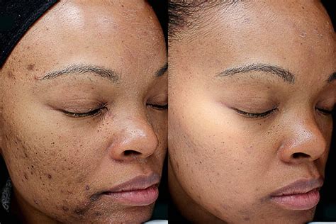 Chemical Peel (VI Peel) Before & After Gallery - Case: 11073