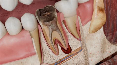 Acute Apical Periodontitis: Etiology, Clinical Manifestations, and ...
