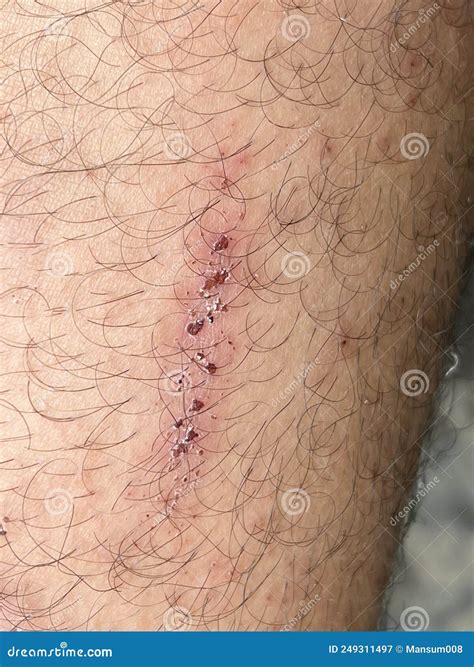 Scar on Skin. the Wound Form Scabs on Leg. Man with Long Scab Wound on ...