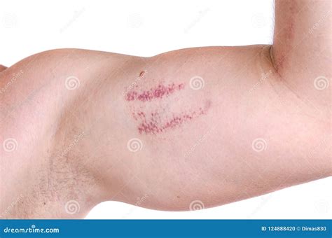Bruise or Scratch or Wound on the Skin of the Hand on the Biceps of a Male Close-up Stock Photo ...