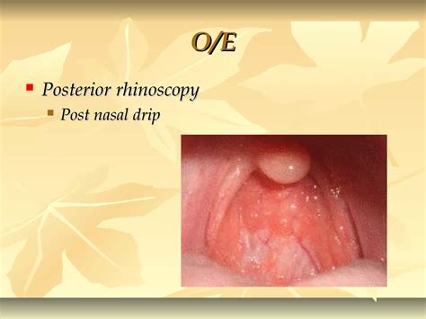 Clinical features and investigations of allergic rhinitis | PPT