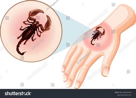 9+ Hundred Scorpion Bite Royalty-Free Images, Stock Photos & Pictures ...