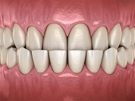How to Remove Tobacco Stains From Your Teeth Naturally?