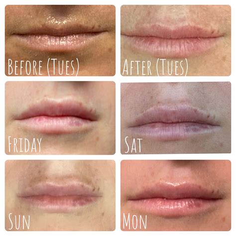 Lip Filler Healing Process Timeline at Betty Ammerman blog