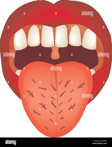 Cracks in the tongue. Definition of a disease according to human tongue. Diagnostics by tongue ...