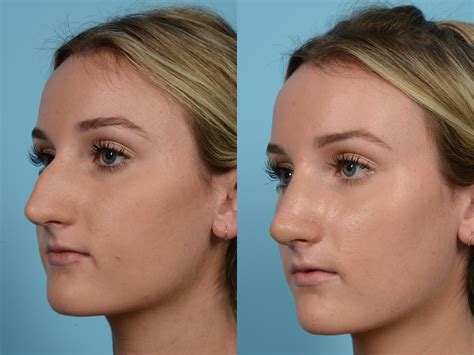 Before After Rhinoplasty Photos Rhinoplasty Nose Surgery Nose | My XXX Hot Girl