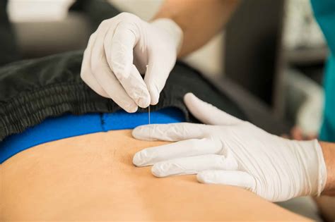 Dry Needling Physical Therapy Treatments | Capitol Physical Therapy ...