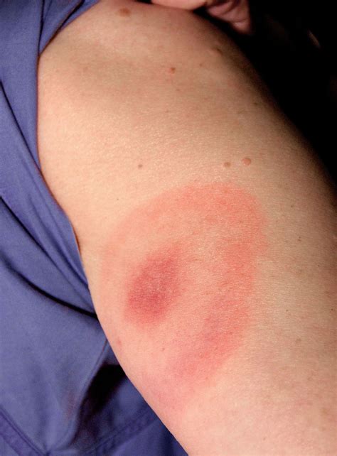Rash | skin condition | Britannica