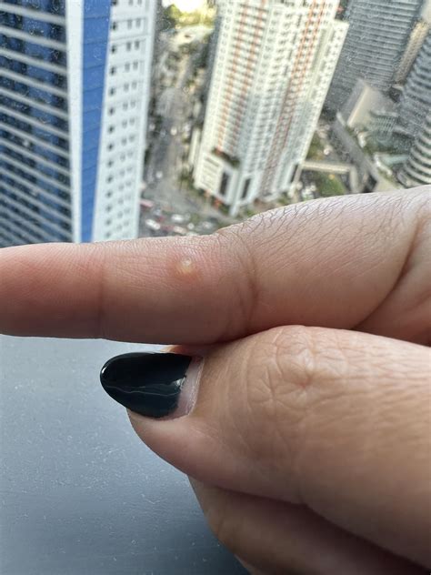 Does anyone know what this bump on my finger is and how to get rid of ...