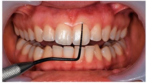 Periodontal Health Parameters in Adults: The Role of the Vestibular Fornix Depth