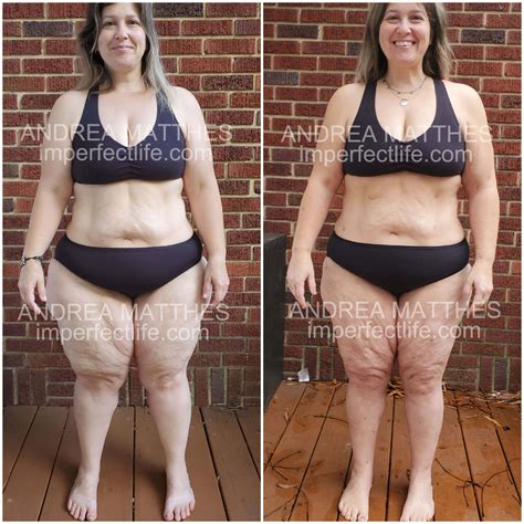 My Lipedema Experience- Welcome - I'mperfect Life