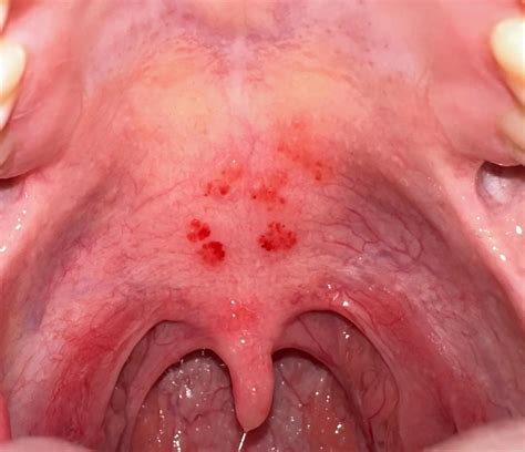 Red Spots on Roof of Mouth | Red Patch in Roof of Mouth
