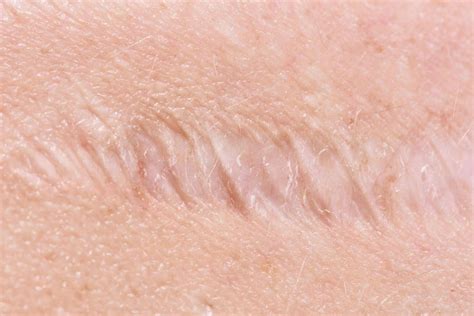 What Is Keloid: 6 Important Points That You Must Know - Icy Health