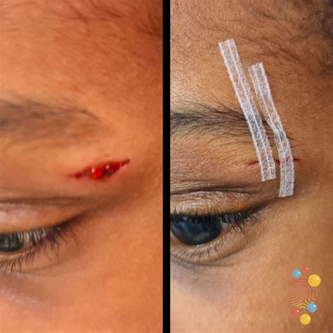 Types Of Cuts Laceration at Cole Sherrell blog