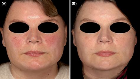 Rosacea treatment with 532 nm KTP versus 595 nm pulsed dye laser—A prospective, controlled study ...