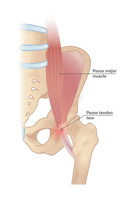 Torn Hip Flexor : Psoas Injuries In Runners Signs Symptoms And Treatments - Zak Willis
